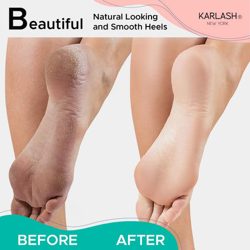Karlash Professional Pedicure Foot Pumice Stone, 2 Sided Callus Remover and Scrubber for Dead Skin (Pack of 2)