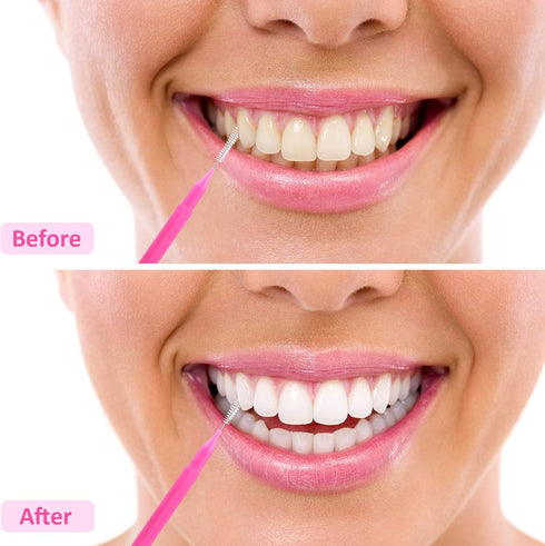 Patelai 100 Pieces Braces Brush for Cleaner Interdental Brush Toothpick Dental Hygiene Flosser Tooth Cleaning Tool