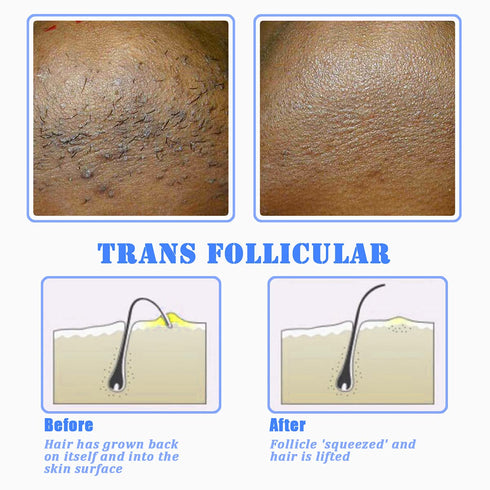 TailaiMei Exfoliating Brush for Ingrown Hair Treatment - Prevent Bikini Bumps, Razor Bumps, Silky Smooth Skin Solution