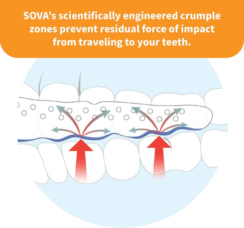 SOVA Junior Night Guard, Purple Punch, 1.6mm Thin, Custom-Molded Fit for Teeth Grinding & Clenching