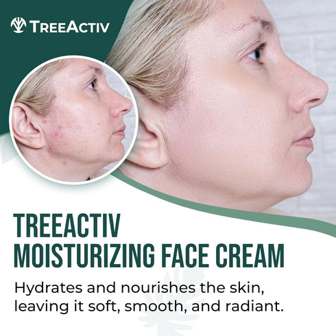 TreeActiv Acne Eliminating Face Cream - Best Natural Extra Strength Fast Acting Treatment for Clearing Facial Acne -