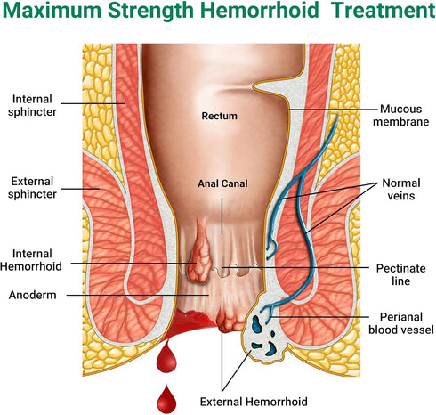 Hemorrhoid Treatment Ointment, Maximum Strength for Pain, Itching, Burning, Swelling, Long-Lasting Hemorrhoid Cream