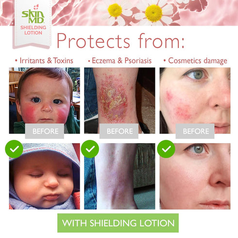 Skin MD Shielding Lotion 4oz, Hydrating Non-Greasy Protection for Sensitive Skin
