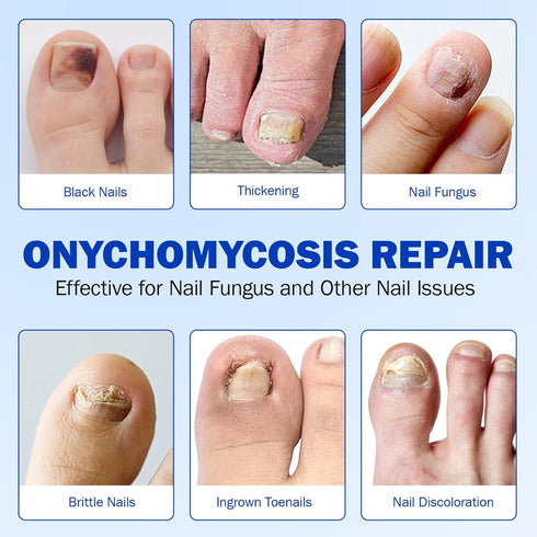 ISUNRISE 42 8-Hour Nail Repair Patches Pcs, Toenail Treatment Extra Strength, Overnight Nail Treatment for Damaged