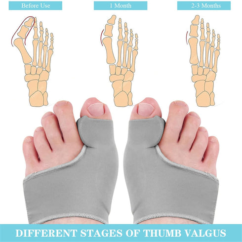 Bunion Corrector for Women Men, Bunion Socks Toe Corrector Big Toe Straightener Separator Pain Relief, 1 Pair