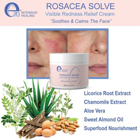 Rosacea Solve - Redness Relief Cream - Face Moisturizer For Rosacea & Acne Prone Skin - Sensitive Skin Care With Organic Ingredients, Almond Oil, Licorice & Chamomile Extracts - No Parabens
