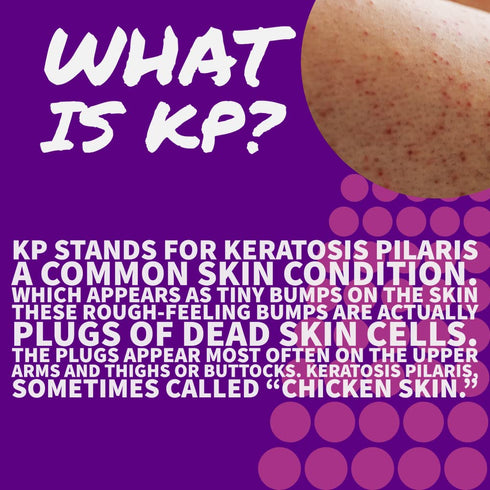 KP Keratosis Pilaris Treatment, Hydrating Lotion for Rough Bumpy Dry Skin, Moisturizing Bumps Be Gone, 8 Oz