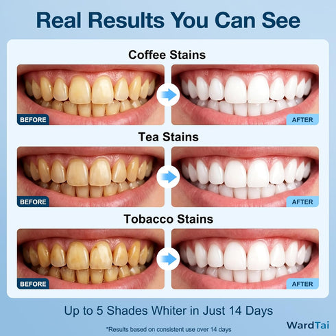 WardTai 32 3X 6 7 Teeth Whitening Kit with LED Accelerator Light, Percent Gentle Hydrogen Peroxide Gel Pens