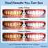WardTai 32 3X 6 7 Teeth Whitening Kit with LED Accelerator Light, Percent Gentle Hydrogen Peroxide Gel Pens