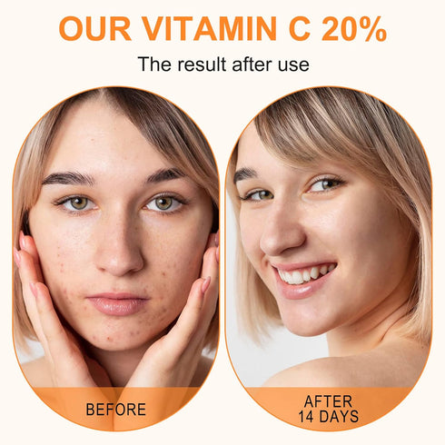 Premium 20% Vitamin C Serum for Face, 60ml, with Hyaluronic Acid, Retinol & Amino Acids for Anti Aging