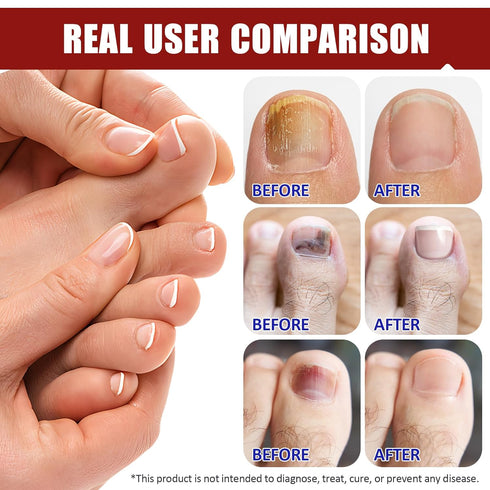 NIFEISHI (32pcs) Fungal Nail Patches for Toenails, Toenail Fungus Treatment Extra Strength for Overnight Toenail Care