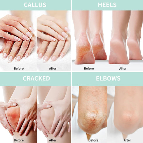 Urea Cream 40 Percent for Feet, Plus 2% Salicylic Acid, 5.29 oz, Maximum Strength Foot and Hand Cream