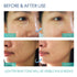 Razor Bumps Treatment for Women and Men, Ingrown Hair Serum for Bikini Area, Face, Neck, Legs, Underarm