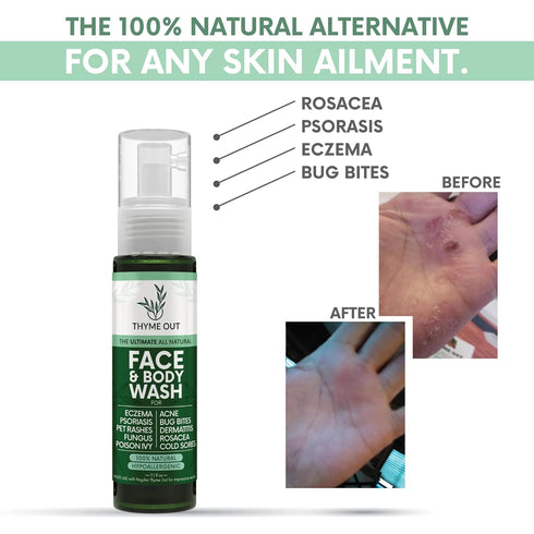 All Natural Face & Body Wash for Eczema, Psoriasis, Bug Bites, 7.1 oz Soothes Itching and Irritation