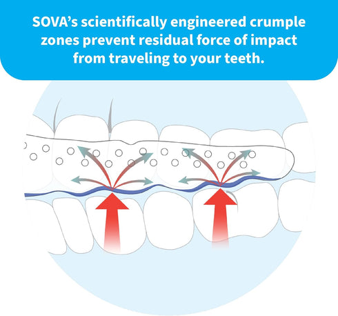 SOVA Aero Night Guard - 1.6mm Thin, Custom-Molded Fit for Nighttime Teeth Grinding & Clenching