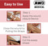 AWD Zip Stitch Wound Closure Strips - 2 Devices, 2 Sterile Gauzes, 2 Alcohol Wipes for Emergency Laceration
