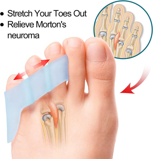 Povihome 10 Pack Pinky Toe Separator for Overlapping Toes, Spacers for Morton's Neuroma Pain Relief
