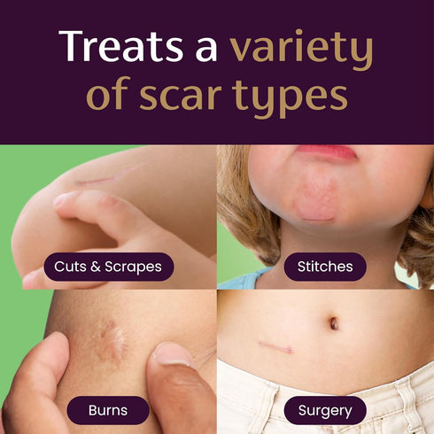 Mederma Scar Gel for Kids - Reduces Appearance of Old & New Scars from Cuts, Burns, Surgery, Insect Bites & Scrapes,