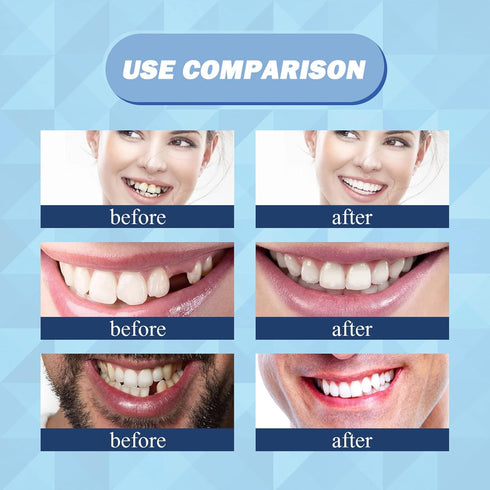 30 ml Temporary Teeth Replacement Kit, Tooth Repair Kit - Moldable Thermal Fitting Beads for Filling Missing Broken