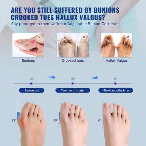 Fitgeno Bunion Corrector for Women & Men Big Toe: Adjustable Foot Straightener Splint Brace for Hallux Valgus Pain