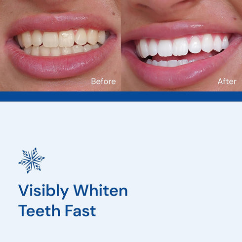 SNOW Diamond Teeth Whitening Strips, Gentle & Enamel Safe for At-Home Dental Hygiene, 14 Ct