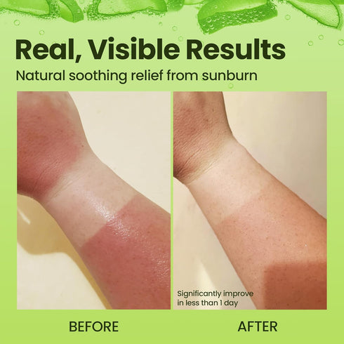 Honeyskin Soothing Aloe Vera Gel - Natural Ingredients for Relief from Sunburn and Dry Skin (8 Fl Oz)