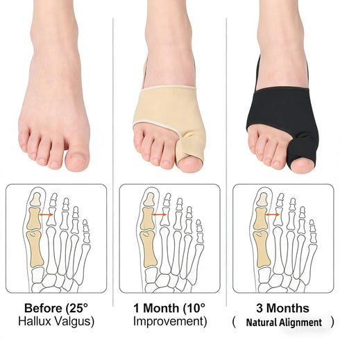 SANHLSKJ 2PCS Bunion Corrector for Women & Men,Hallux Valgus Pain Relief Toe Straightener,Non-Slip Stitched Gel
