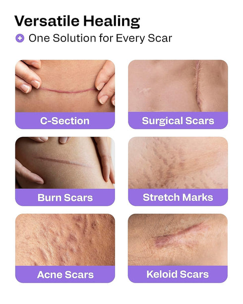 AWD Silicone Scar Sheets for Surgical Scars, Medical Grade Silicone Scar Tape for C Section, 1.6" x 120" Roll