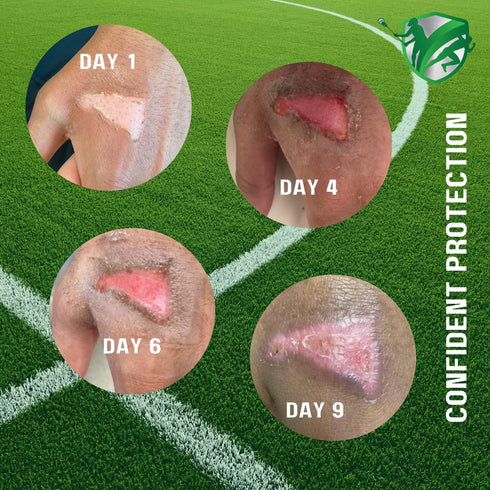 TURFGUARD Turf Burn and Wound Dressing, 2" x 3" Hydrogel Pads with X-Static Silver, Soothing Cooling Protective