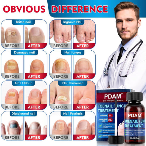 PDAM 30ml Toenail Fungus Treatment Extra Strength - Toe Nail Fungus Treatments for Thick, Nail Strengthener and Growth