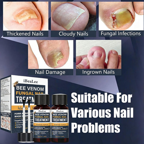 KISMIGER -1% 2 Toenail Fungus Treatment Extra Strength Tolnaftate, Bee Venom Nail Fungus Treatment, Gentle Fungal Nail