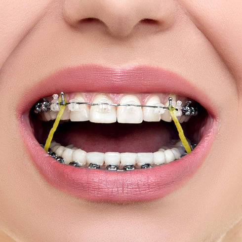 JMU Orthodontic Elastics 3/8 Heavy, 300 Pack of Rubber Bands, Intraoral Latex Dental Bands