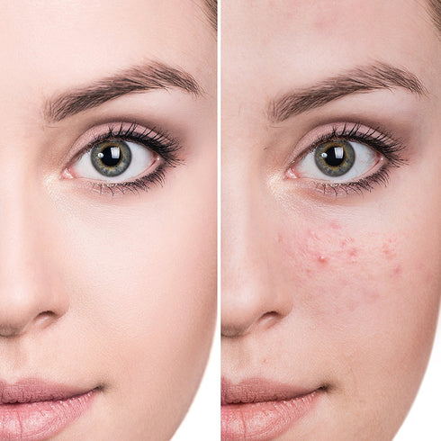 Quick Clear Blemish Control Acne Spot Treatment, Drying Lotion for Face, Back, Chest