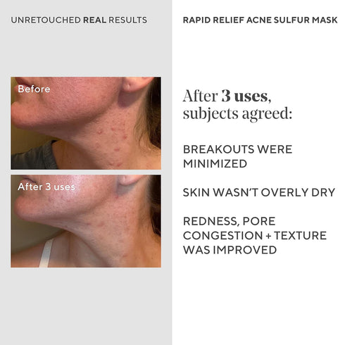 Murad Rapid Relief Acne Sulfur Mask - Acne Control Clay Face Mask with Salicylic Acid - 2.5 fl oz