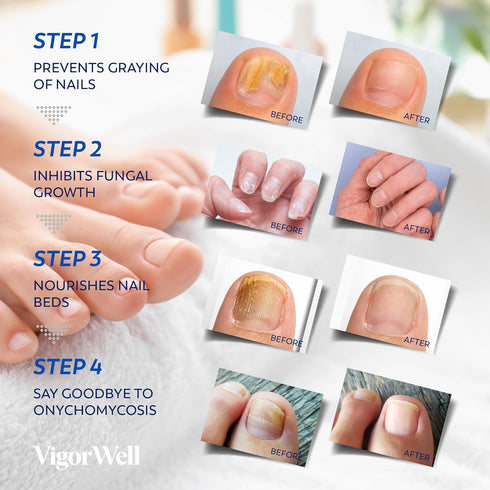 Toenail Fungus Treatment Extra Strength, 32 Hydrogel Patches for Overnight Repair of Fungus Nail