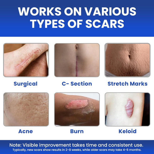 AWD Silicone Scar Sheets for Scar Removal, Extra Thick 0.5mm Silicone Scar Tape for Surgical Scars, C Section, Keloid