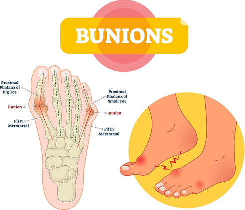 pedag Bunion Protector and Forefoot Pad - Cushions and Protects Bunions, Reusable, Washable, Large/X-Large