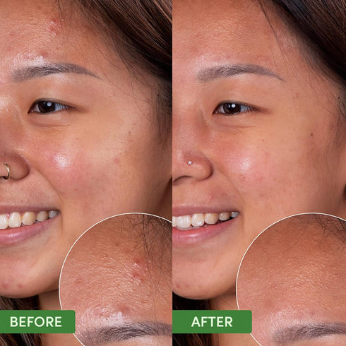 Sand & Sky Oil Control Clearing Cleanser - Gentle Daily Face Wash for Oily Acne Prone Sensitive Skin