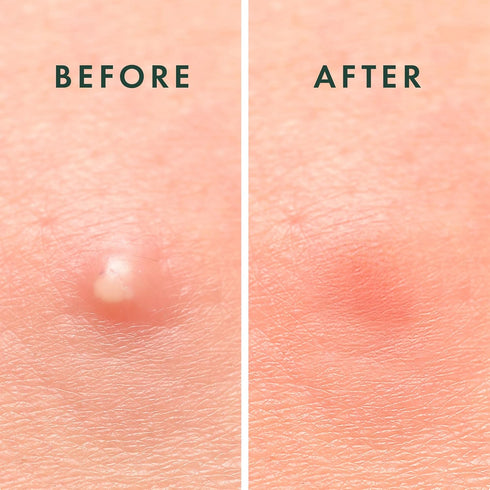 Rael Pimple Patches - Miracle Invisible Hydrocolloid Acne Patch for Breakouts, Absorbs Zits & Blemish, Korean Skin Care