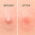 Rael Pimple Patches - Miracle Invisible Hydrocolloid Acne Patch for Breakouts, Absorbs Zits & Blemish, Korean Skin Care