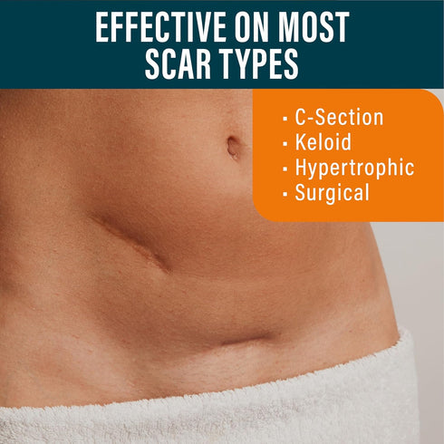 NUVADERMIS Silicone Scar Sheets, Extra Long Reusable Medical Grade for C-Section, Tummy Tuck, Pack of 4 - Light Tone