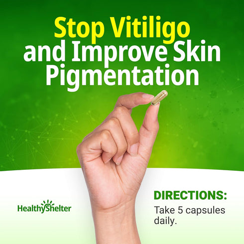 Say Goodbye to Vitiligo and White Spots with Effective Skin Pigmentation Treatment Seronex, Use with Repigmentation