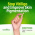 Say Goodbye to Vitiligo and White Spots with Effective Skin Pigmentation Treatment Seronex, Use with Repigmentation