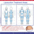 KUSMOO 5 Pack 8" 11" Lipo Foam Pads for Post Surgery Ab Board Liposuction Surgery Flattening Abdominal Compression