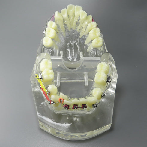 Dental Malocclusion Orthodontic Treatment Teeth Model with Metal Brackets, Colorful Ties, and Chains