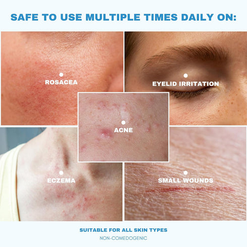 0.015% Hypochlorous Acid Spray - HOCL | Antibacterial Sensitive Skin Toner for Face and Body | Acne, Eczema, Redness