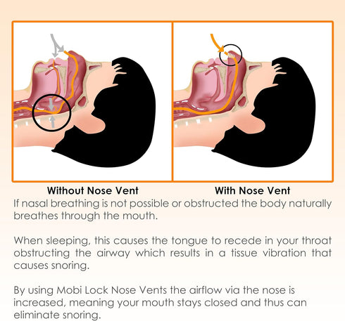 Nose Vent Sinus Relief Dilator (Pack of 12 Large Size) - Reusable Silicone Vents for Nasal Snorers by Mobi Lock