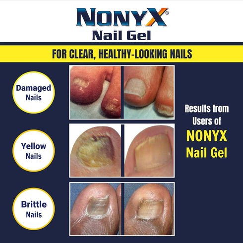 Nail Clarifying Gel, Clinically Proven for Discolored and Damaged Toenails, Effective Treatment