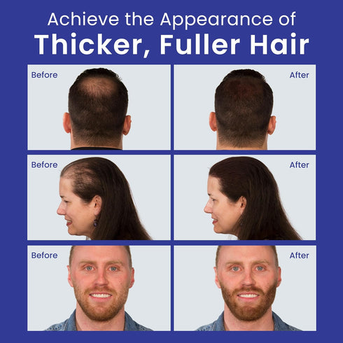 INFINITY Hair Fibers Dark Brown - 100% Undetectable Hair Building Fiber Powder, 15g