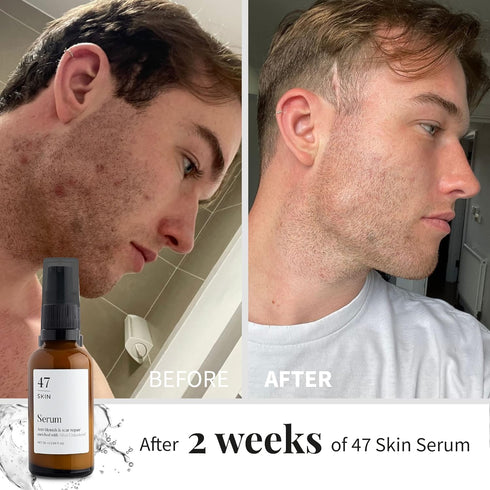 Hydrating Face Serum for Clearing Acne & Scars, Anti-Blemish & Scar Repair Serum for All Skin Types (1.01 oz)